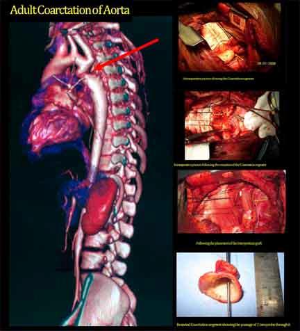 Aorta