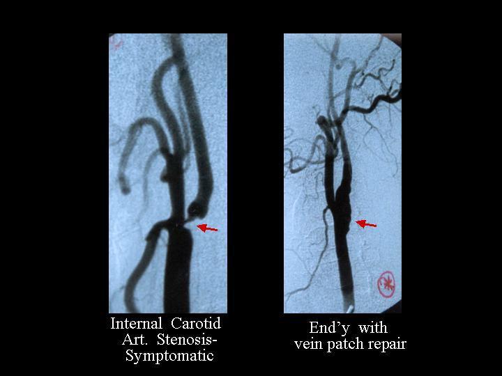 Carotid