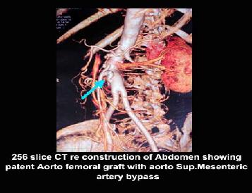 Mesenteric