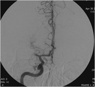 MCA occlusion